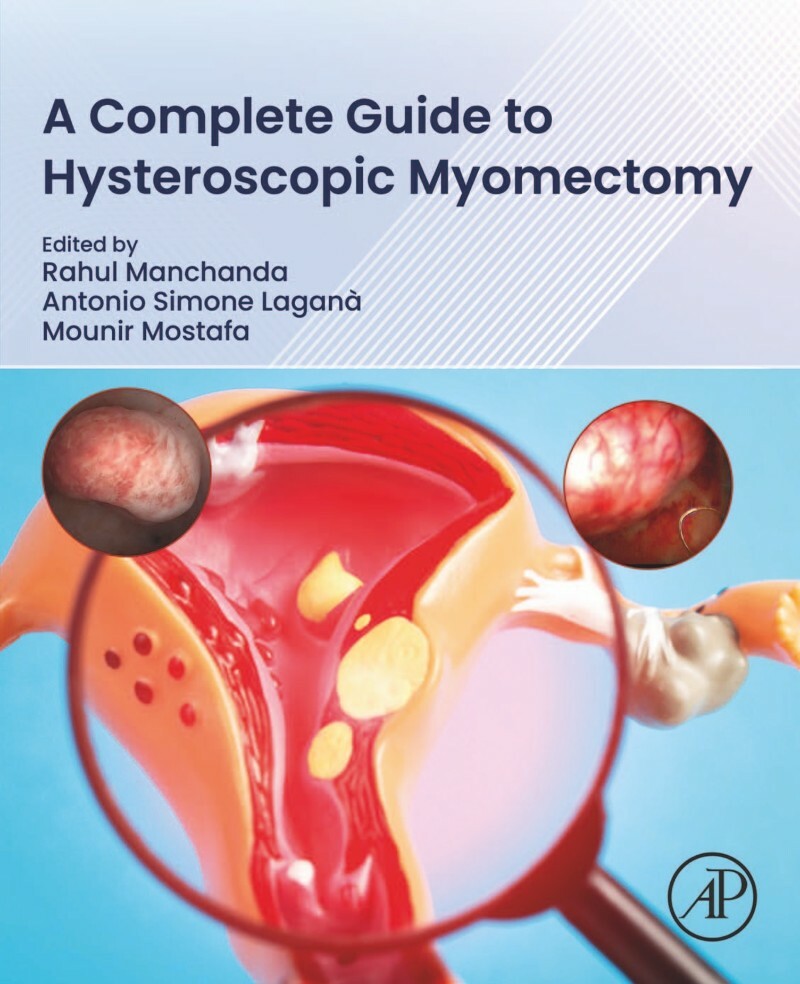 A Complete Guide To Hysteroscopic Myomectomy (Rahul Manchanda) A Complete Guide To Hysteroscopic Myomectomy (Rahul Manchanda)